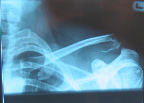 Röntgenbild 1